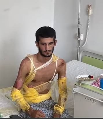 Başçıya etiraz olaraq özünü yandıran Qarabağ Qazisi AĞIR DURUMDA... Başçıya etiraz olaraq özünü yandıran Qarabağ Qazisi AĞIR DURUMDA...